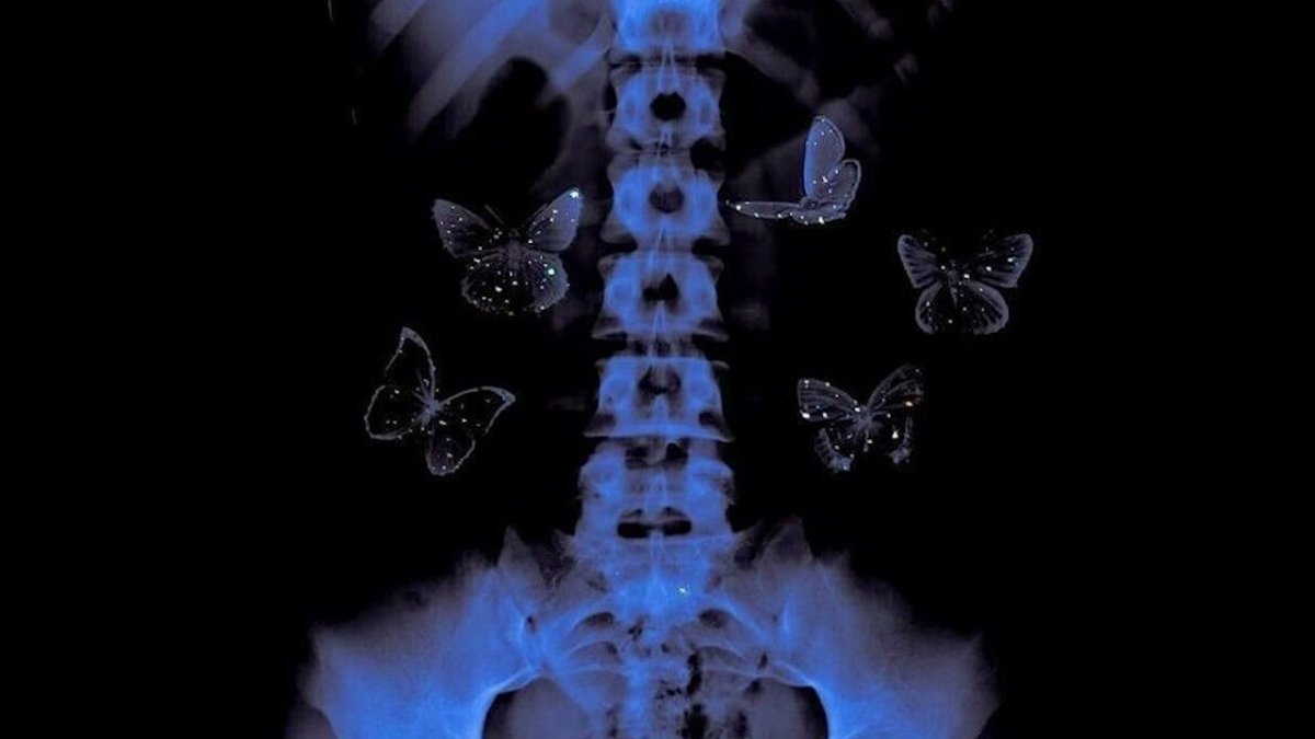 Бабочки в животе. Бабочки в животе рентген. Бабочки в животе фото. Бабочки в животе картинки прикольные. Бабочки в животе кто поет